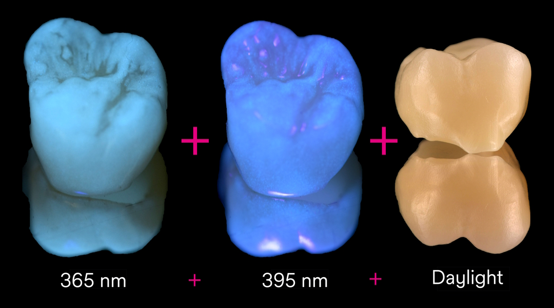 Tooth compared under 365nm UV light, 395nm UV light, and daylight